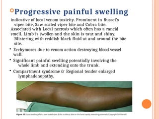 Progressive painful swelling
indicative of local venom toxicity. Prominent in Russel’s
viper bite, Saw scaled viper bite and Cobra bite.
Associated with Local necrosis which often has a rancid
smell. Limb is swollen and the skin is taut and shiny.
Blistering with reddish black fluid at and around the bite
site.
• Ecchymoses due to venom action destroying blood vessel
wall.
• Significant painful swelling potentially involving the
whole limb and extending onto the trunk.
• Compartment syndrome & Regional tender enlarged
lymphadenopathy.
 