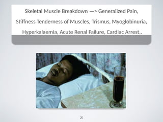 Skeletal Muscle Breakdown —> Generalized Pain,
Stiﬀness Tenderness of Muscles, Trismus, Myoglobinuria,
Hyperkalaemia, Acute Renal Failure, Cardiac Arrest,.
20
 