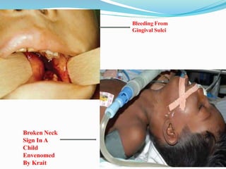 Broken Neck
Sign In A
Child
Envenomed
By Krait
Bleeding From
Gingival Sulci
 