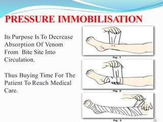 PRESSURE IMMOBILISATION
Its Purpose Is To Decrease
Absorption Of Venom
From Bite Site Into
Circulation.
Thus Buying Time For The
Patient To Reach Medical
Care.
 