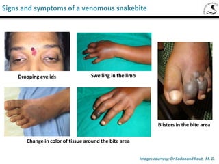 These images of actual bite marks by
venomous snakes show that marks may
or may not be clearly visible.
Bite marks dependent on the type and
size of snake in question.
Images courtesy: Dr Sadanand Raut, M. D.
Saw-Scaled Viper
Common locations of snake bites
 