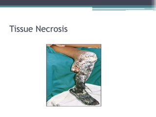 Tissue Necrosis
 