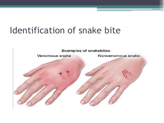 Snake Bite Management