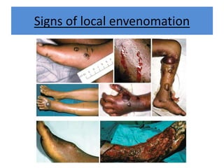 Signs of local envenomation
 