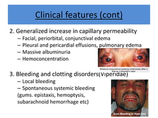 Clinical features (cont)
2. Generalized increase in capillary permeability
– Facial, periorbital, conjunctival edema
– Pleural and pericardial effusions, pulmonary edema
– Massive albuminuria
– Hemoconcentration
3. Bleeding and clotting disorders(Viperidae)
– Local bleeding
– Spontaneous systemic bleeding
(gums. epistaxis, hemoptysis,
subarachnoid hemorrhage etc)
 