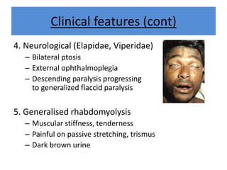 Clinical features (cont)
4. Neurological (Elapidae, Viperidae)
– Bilateral ptosis
– External ophthalmoplegia
– Descending paralysis progressing
to generalized flaccid paralysis
5. Generalised rhabdomyolysis
– Muscular stiffness, tenderness
– Painful on passive stretching, trismus
– Dark brown urine
 