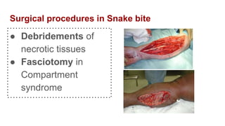 Surgical procedures in Snake bite
● Debridements of
necrotic tissues
● Fasciotomy in
Compartment
syndrome
 