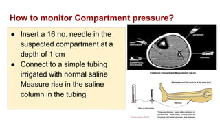 How to monitor Compartment pressure?
● Insert a 16 no. needle in the
suspected compartment at a
depth of 1 cm
● Connect to a simple tubing
irrigated with normal saline
Measure rise in the saline
column in the tubing
 