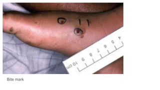 Bite mark
 