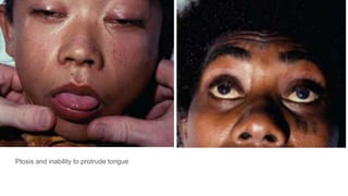 Ptosis and inability to protrude tongue
 