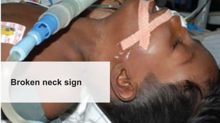 Broken neck sign
 