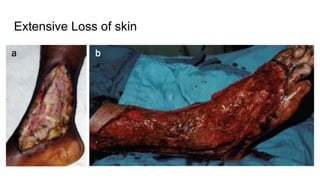 Extensive Loss of skin
 