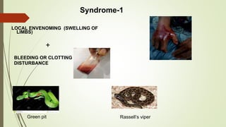 Syndrome-1
LOCAL ENVENOMING (SWELLING OF
LIMBS)
+
BLEEDING OR CLOTTING
DISTURBANCE
Green pit Rassell’s viper
 