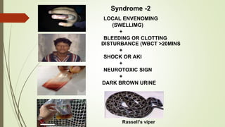 Syndrome -2
LOCAL ENVENOMING
(SWELLIMG)
+
BLEEDING OR CLOTTING
DISTURBANCE (WBCT >20MINS
+
SHOCK OR AKI
+
NEUROTOXIC SIGN
+
DARK BROWN URINE
Rassell’s viper
 