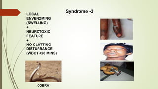 LOCAL
ENVENOMING
(SWELLING)
+
NEUROTOXIC
FEATURE
+
NO CLOTTING
DISTURBANCE
(WBCT <20 MINS)
Syndrome -3
COBRA
 