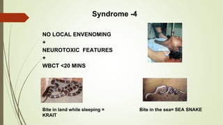 Syndrome -4
NO LOCAL ENVENOMING
+
NEUROTOXIC FEATURES
+
WBCT <20 MINS
Bite in land while sleeping =
KRAIT
Bite in the sea= SEA SNAKE
 
