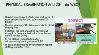 PHYSICAL EXAMINATION And 20- min WBCT
 Careful assessment of bite site and signs of
local envenomation and examination of
patient
 Monitor vitals and Do 20 minute whole blood
clotting time
 If clotted, the test should be carried out
every 1 hr from admission for three hrs and
then 6 hrly for 24hrs
 In not clotted, repeat 6 hrs after
administering loading dose of ASV
 In case of neurotoxic envenomation repeat
clotting test after 6 hrs
 