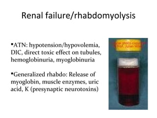Renal failure/rhabdomyolysis

ATN: hypotension/hypovolemia,
DIC, direct toxic effect on tubules,
hemoglobinuria, myoglobinuria

Generalized rhabdo: Release of
myoglobin, muscle enzymes, uric
acid, K (presynaptic neurotoxins)
 