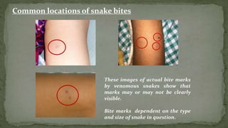 These images of actual bite marks
by venomous snakes show that
marks may or may not be clearly
visible.
Bite marks dependent on the type
and size of snake in question.
Common locations of snake bites
 