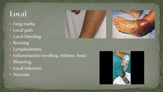 Fang marks
 Local pain
 Local bleeding
 Bruising
 Lymphadenitis
 Inflammation (swelling, redness, heat)
 Blistering
 Local infection
 Necrosis
 