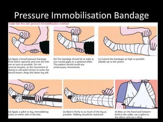 Pressure Immobilisation Bandage
 