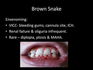Brown Snake
Envenoming:
• VICC- bleeding gums, cannula site, ICH.
• Renal failure & oliguria infrequent.
• Rare – diplopia, ptosis & MAHA.
 