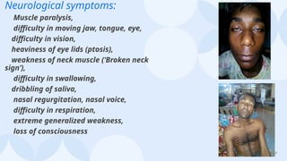 17
Neurological symptoms:
Muscle paralysis,
difficulty in moving jaw, tongue, eye,
difficulty in vision,
heaviness of eye lids (ptosis),
weakness of neck muscle (‘Broken neck
sign’),
difficulty in swallowing,
dribbling of saliva,
nasal regurgitation, nasal voice,
difficulty in respiration,
extreme generalized weakness,
loss of consciousness
 