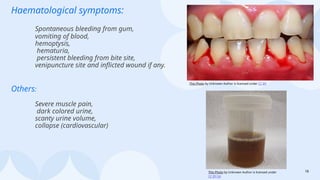18
Haematological symptoms:
Spontaneous bleeding from gum,
vomiting of blood,
hemoptysis,
hematuria,
persistent bleeding from bite site,
venipuncture site and inflicted wound if any.
Others:
Severe muscle pain,
dark colored urine,
scanty urine volume,
collapse (cardiovascular)
This Photo by Unknown Author is licensed under CC BY
This Photo by Unknown Author is licensed under
CC BY-SA
 