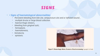 19
SIGNS
• • Signs of haematological abnormalities:
• Persistent bleeding from bite site, venipuncture site and or inflicted wound ,
• multiple bruise or large blood collection
• haemorrhagic blisters,
• bleeding from gingival sulci,
• hemoptysis,
• haematemesis,
• hematuria,
• epistaxis.
 