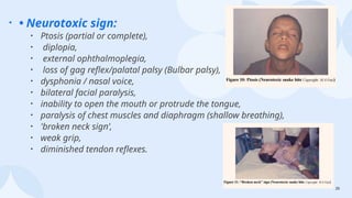 20
• • Neurotoxic sign:
• Ptosis (partial or complete),
• diplopia,
• external ophthalmoplegia,
• loss of gag reflex/palatal palsy (Bulbar palsy),
• dysphonia / nasal voice,
• bilateral facial paralysis,
• inability to open the mouth or protrude the tongue,
• paralysis of chest muscles and diaphragm (shallow breathing),
• 'broken neck sign’,
• weak grip,
• diminished tendon reflexes.
 
