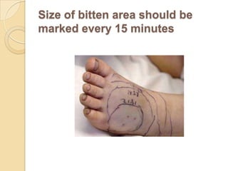 Size of bitten area should be
marked every 15 minutes
 