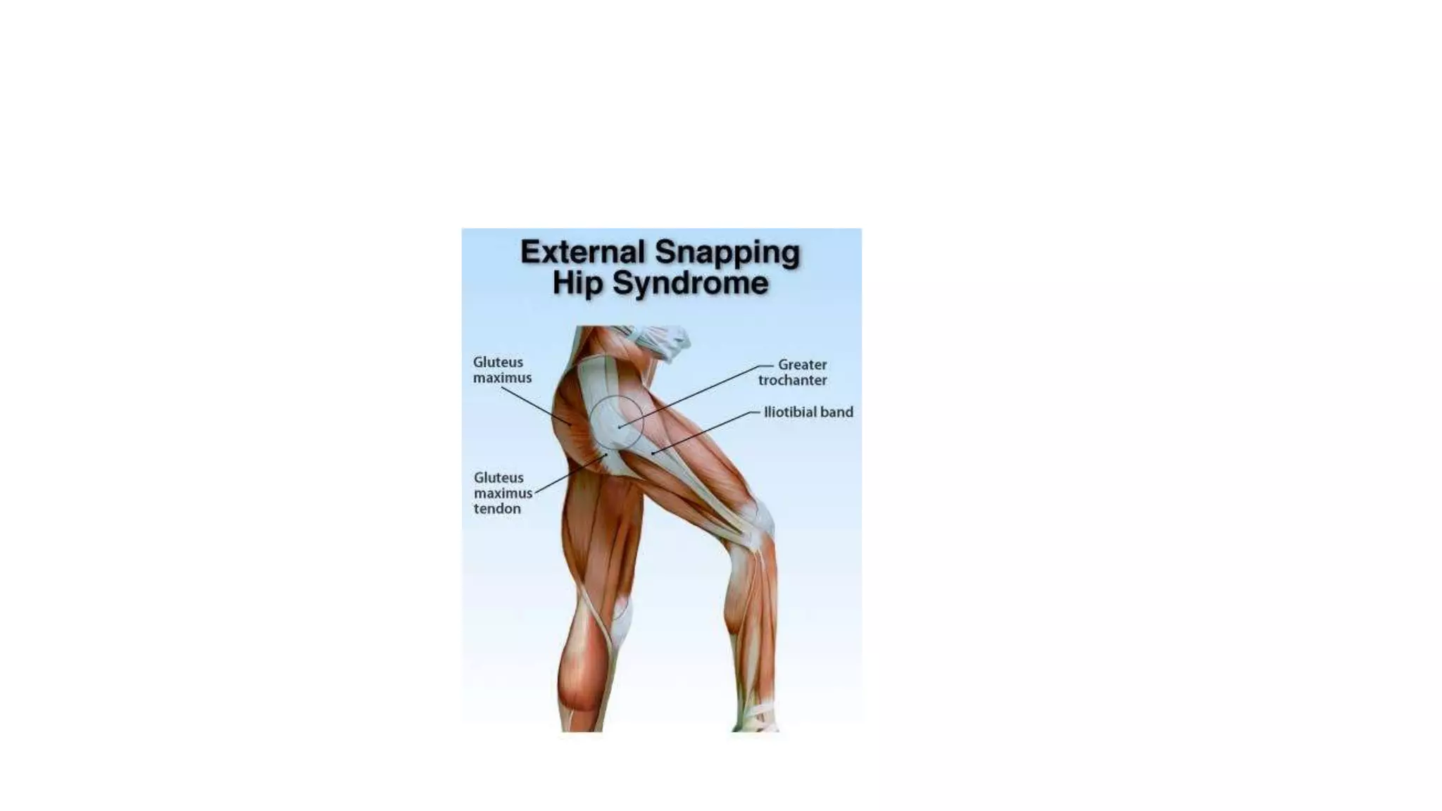 Left Snapping Hip Snapping hip syndrome | PPTX