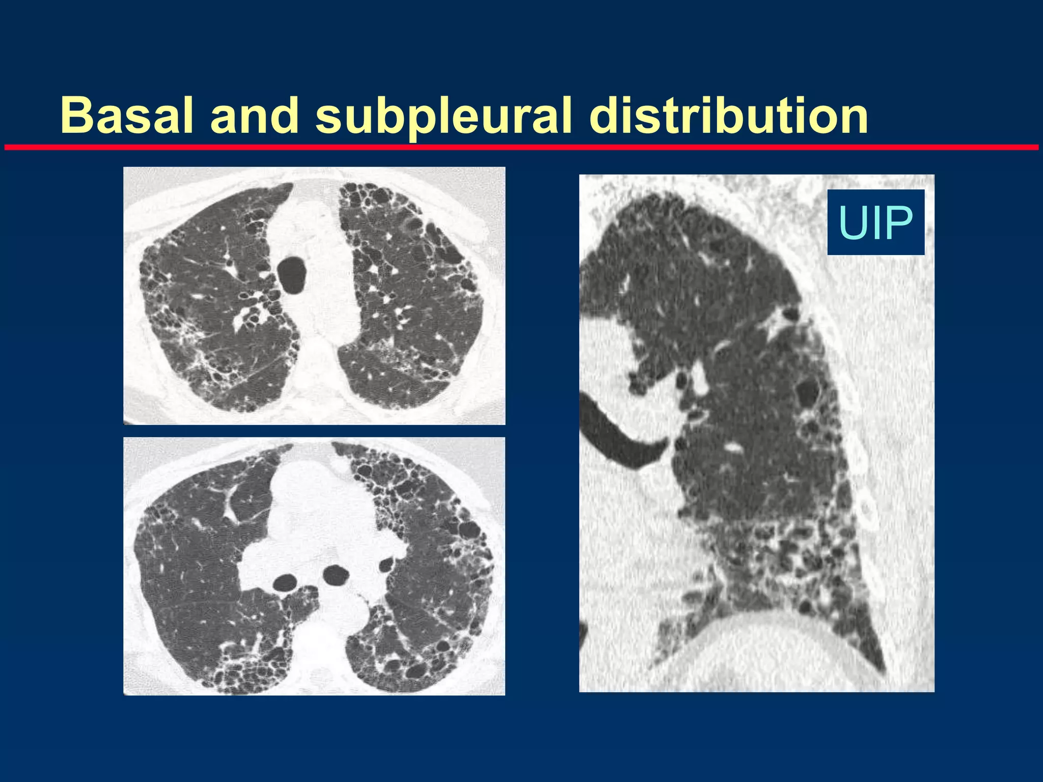 Basal and subpleural distribution
UIP
 
