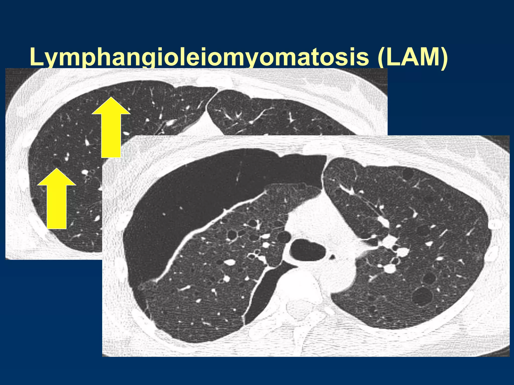 Lymphangioleiomyomatosis (LAM)
 