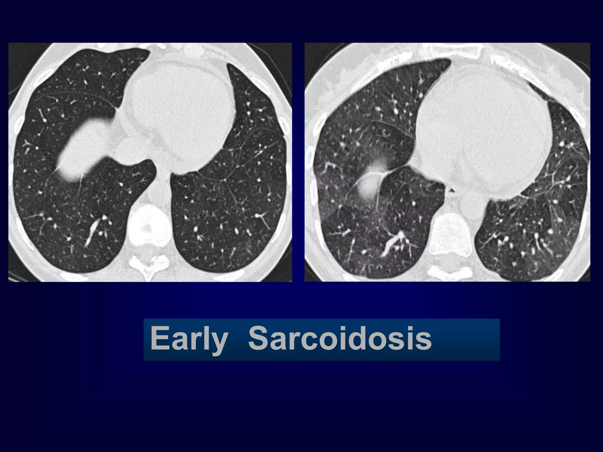 Early Sarcoidosis
 
