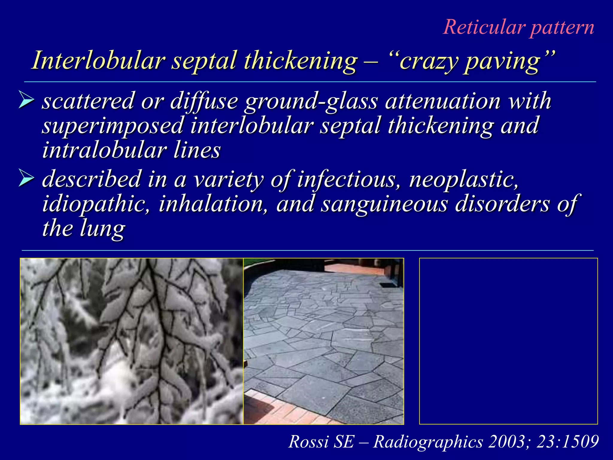 Reticular pattern
Interlobular septal thickening – “crazy paving”
 scattered or diffuse ground-glass attenuation with
superimposed interlobular septal thickening and
intralobular lines
 described in a variety of infectious, neoplastic,
idiopathic, inhalation, and sanguineous disorders of
the lung
Rossi SE – Radiographics 2003; 23:1509
 