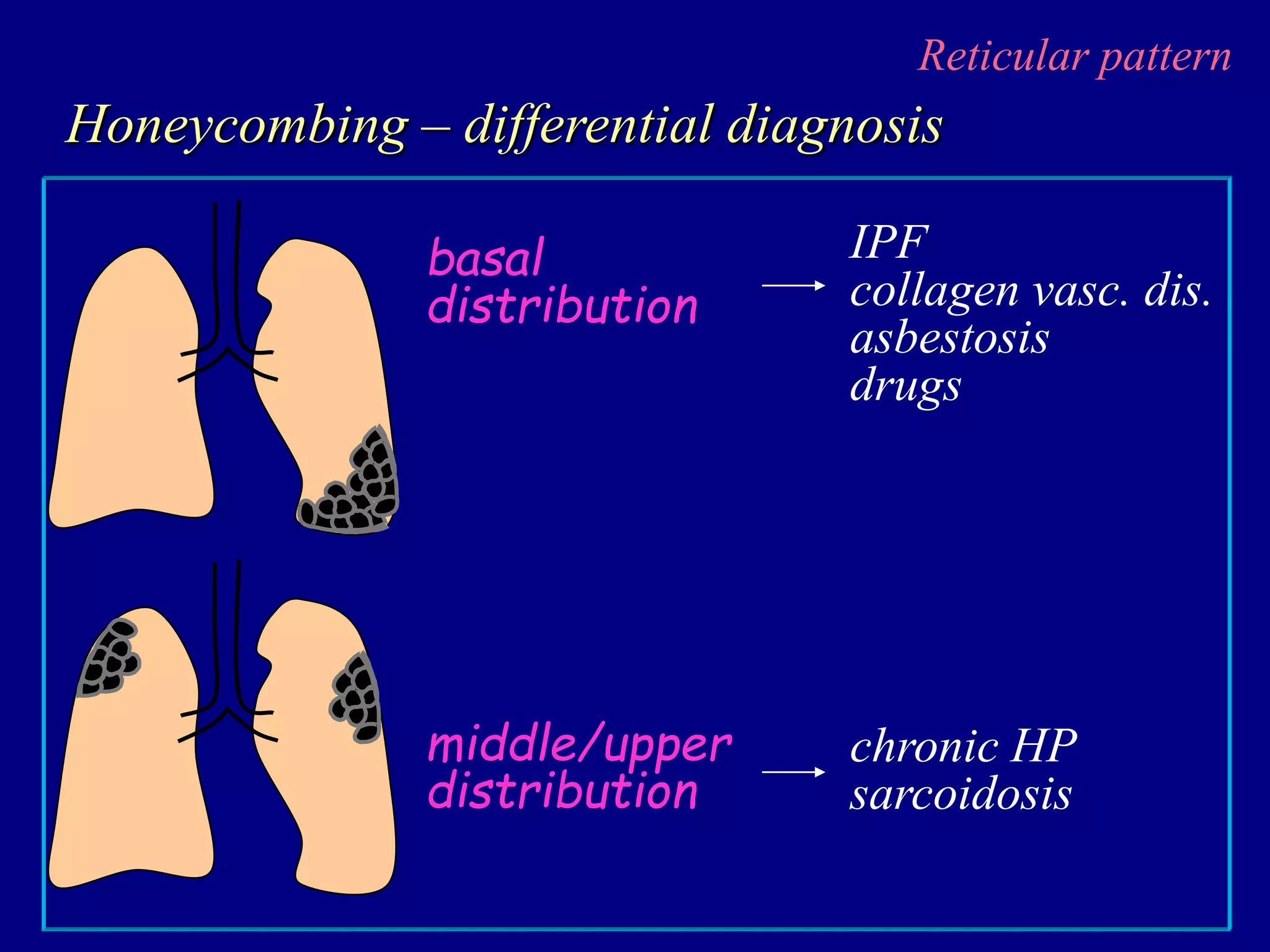 Reticular pattern
Honeycombing – differential diagnosis
basal
distribution
middle/upper
distribution
chronic HP
sarcoidosis
IPF
collagen vasc. dis.
asbestosis
drugs
 