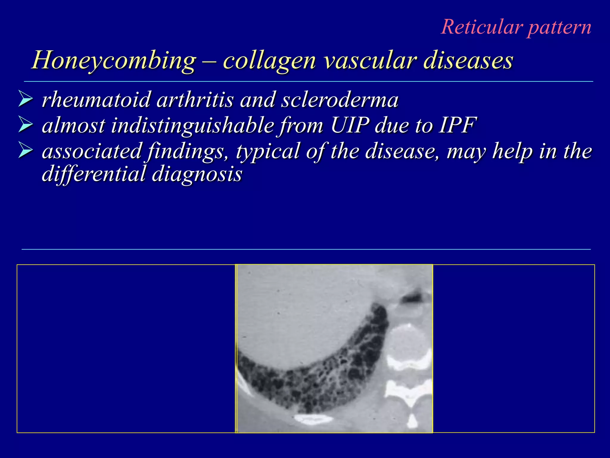 Reticular pattern
Honeycombing – collagen vascular diseases
 rheumatoid arthritis and scleroderma
 almost indistinguishable from UIP due to IPF
 associated findings, typical of the disease, may help in the
differential diagnosis
 