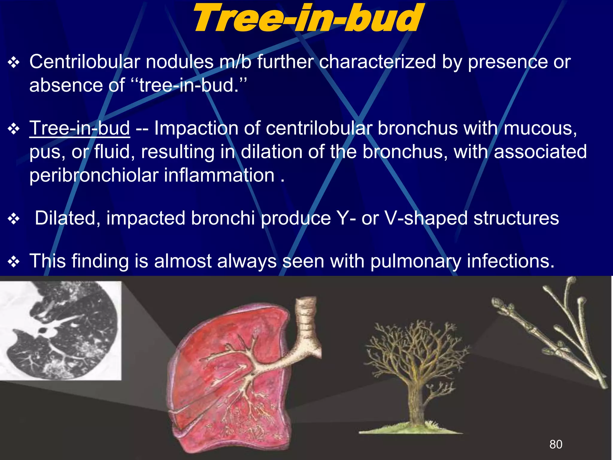Tree-in-bud
 Centrilobular nodules m/b further characterized by presence or
absence of ‘‘tree-in-bud.’’
 Tree-in-bud -- Impaction of centrilobular bronchus with mucous,
pus, or fluid, resulting in dilation of the bronchus, with associated
peribronchiolar inflammation .
 Dilated, impacted bronchi produce Y- or V-shaped structures
 This finding is almost always seen with pulmonary infections.
80
 
