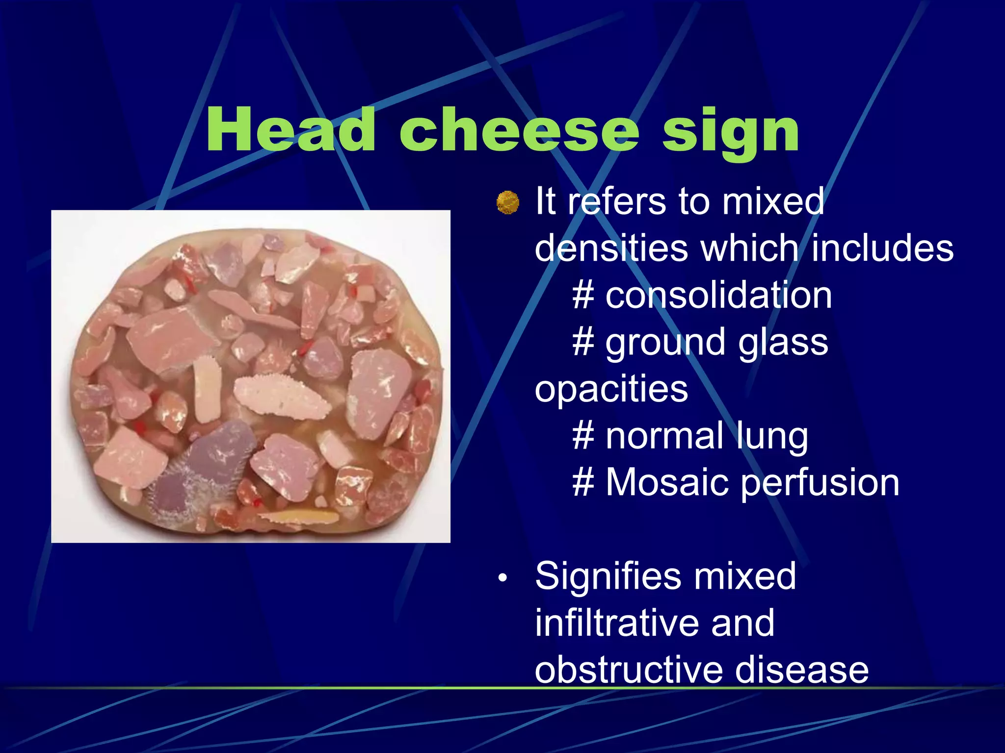 Head cheese sign
It refers to mixed
densities which includes
# consolidation
# ground glass
opacities
# normal lung
# Mosaic perfusion
• Signifies mixed
infiltrative and
obstructive disease
 