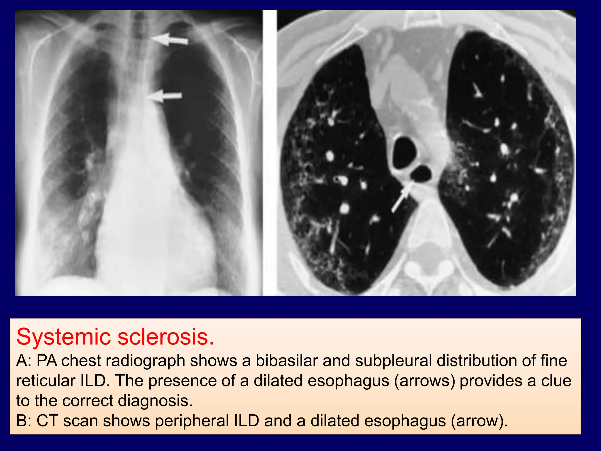 Systemic sclerosis.
A: PA chest radiograph shows a bibasilar and subpleural distribution of fine
reticular ILD. The presence of a dilated esophagus (arrows) provides a clue
to the correct diagnosis.
B: CT scan shows peripheral ILD and a dilated esophagus (arrow).
 