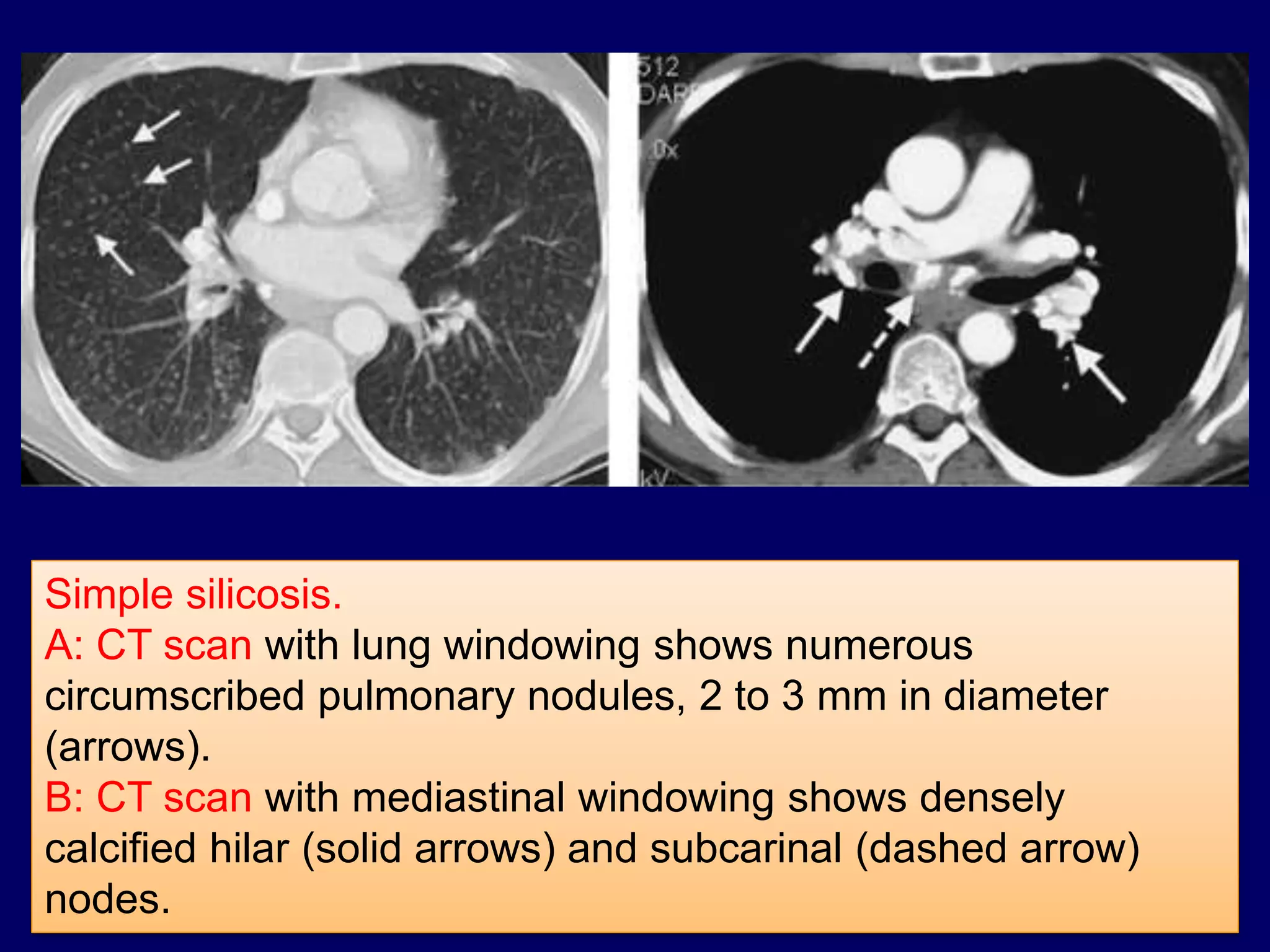 Simple silicosis.
A: CT scan with lung windowing shows numerous
circumscribed pulmonary nodules, 2 to 3 mm in diameter
(arrows).
B: CT scan with mediastinal windowing shows densely
calcified hilar (solid arrows) and subcarinal (dashed arrow)
nodes.
 