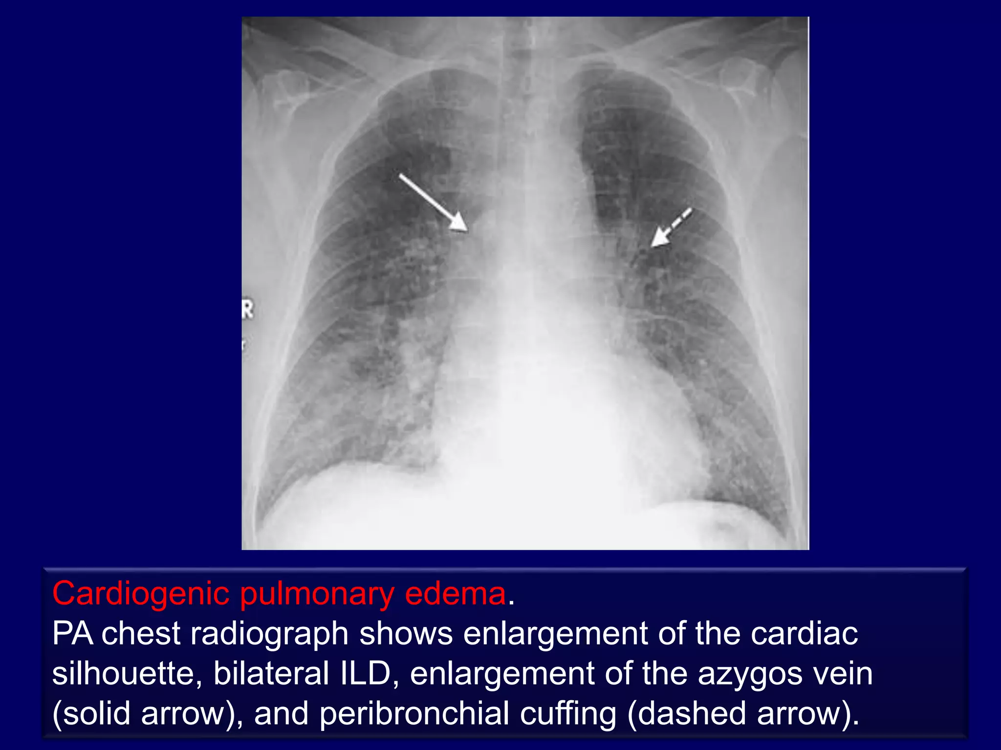 Cardiogenic pulmonary edema.
PA chest radiograph shows enlargement of the cardiac
silhouette, bilateral ILD, enlargement of the azygos vein
(solid arrow), and peribronchial cuffing (dashed arrow).
 