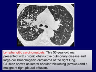 Lymphangitic carcinomatosis. This 53-year-old man
presented with chronic obstructive pulmonary disease and
large-cell bronchogenic carcinoma of the right lung.
CT scan shows unilateral nodular thickening (arrows) and a
malignant right pleural effusion.
 