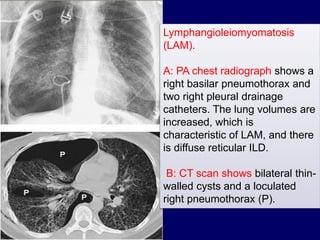 Lymphangioleiomyomatosis
(LAM).
A: PA chest radiograph shows a
right basilar pneumothorax and
two right pleural drainage
catheters. The lung volumes are
increased, which is
characteristic of LAM, and there
is diffuse reticular ILD.
B: CT scan shows bilateral thin-
walled cysts and a loculated
right pneumothorax (P).
 