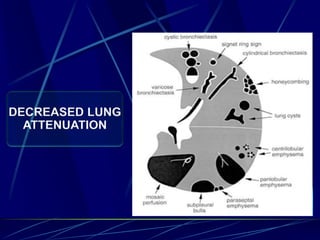 DECREASED LUNG
ATTENUATION
 