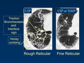Rough Reticular Fine Reticular
Traction
Bronchiectasis
and
Interface
sign
Honey
combing
UIP UIP or NSIP
 