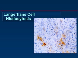 Langerhans Cell
Histiocytosis
 