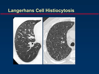 Langerhans Cell Histiocytosis
 