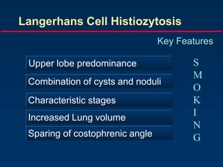 Langerhans Cell Histiozytosis
Key Features
Upper lobe predominance
Combination of cysts and noduli
Characteristic stages
Increased Lung volume
Sparing of costophrenic angle
S
M
O
K
I
N
G
 